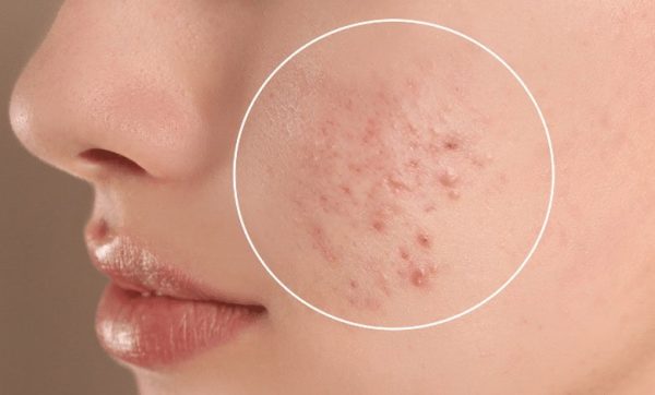 چرا با وجود روتین پوست، هنوز جوش می‌زنیم