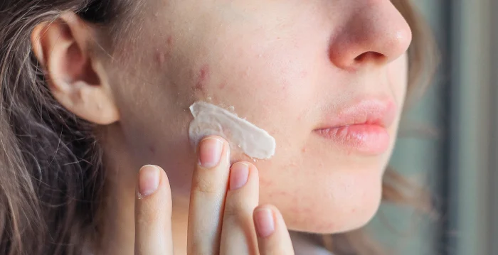 خداحافظی با جوش و برق ناخواسته