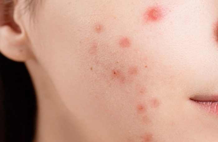 خداحافظی با جوش و برق ناخواسته