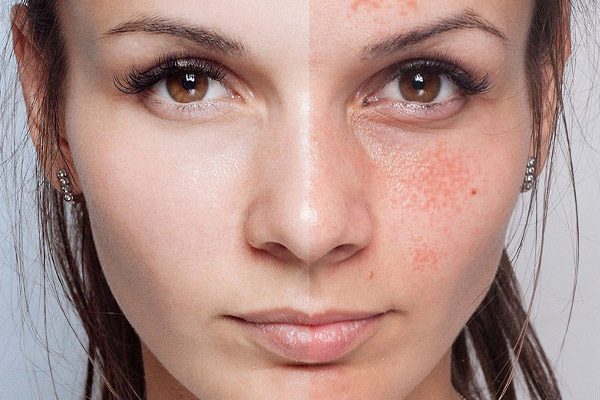 راهنمای جامع کاهش لک‌های پوستی با محصولات مراقبتی