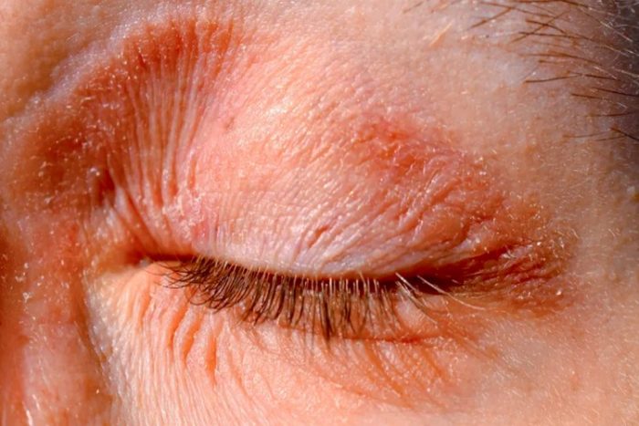 علت و درمان خانگی خشکی دور چشم