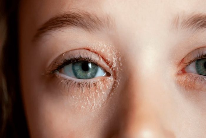 علت و درمان خانگی خشکی دور چشم