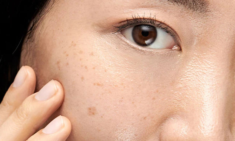 چگونه لک‌های پوستی را با ترکیبات طبیعی در ۱۴ روز به طور مؤثر محو کنیم؟