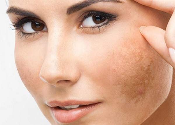 چگونه محصولات مراقبت از پوست با لک‌های تیره مبارزه می‌کنند؟