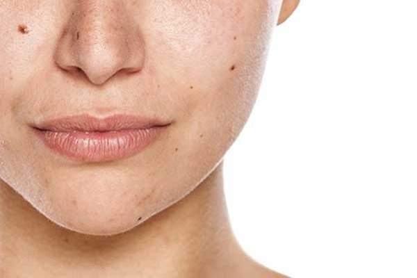 چگونه محصولات مراقبت از پوست با لک‌های تیره مبارزه می‌کنند؟