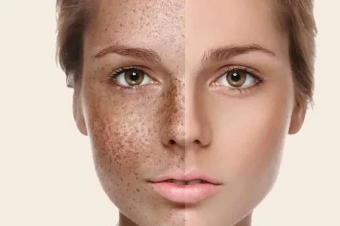 چگونه محصولات مراقبت از پوست با لک‌های تیره مبارزه می‌کنند؟