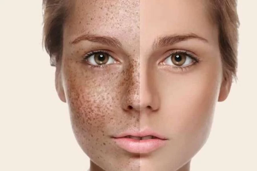 چگونه محصولات مراقبت از پوست با لک‌های تیره مبارزه می‌کنند؟