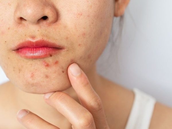 چگونه محصولات مراقبت از پوست به تعادل هورمونی پوست کمک می‌کنند؟